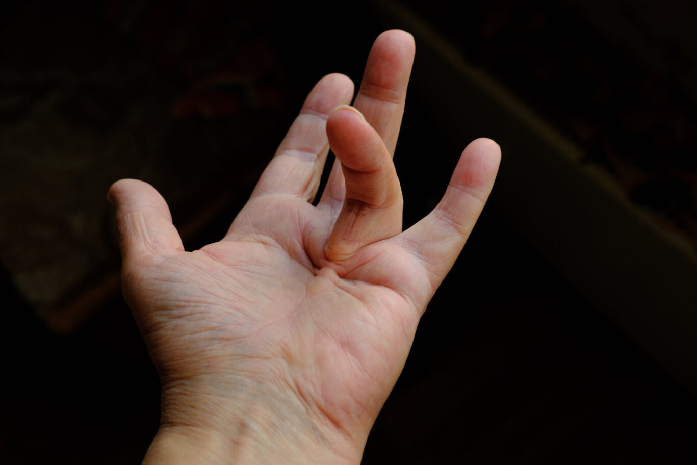 Hand of a person with Dupuytren’s contracture, which does not allow to bend the finger