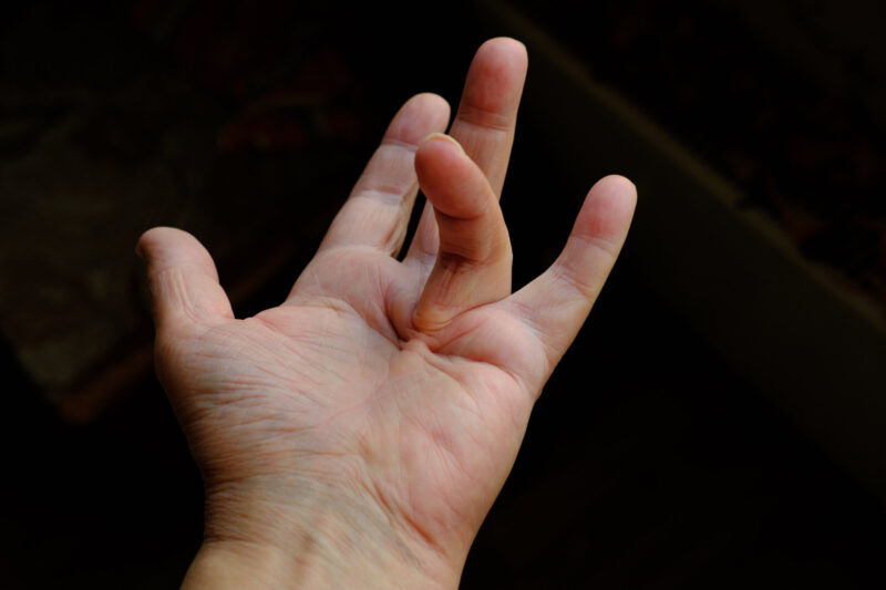 Hand of a person with Dupuytren’s contracture, which does not allow to bend the finger