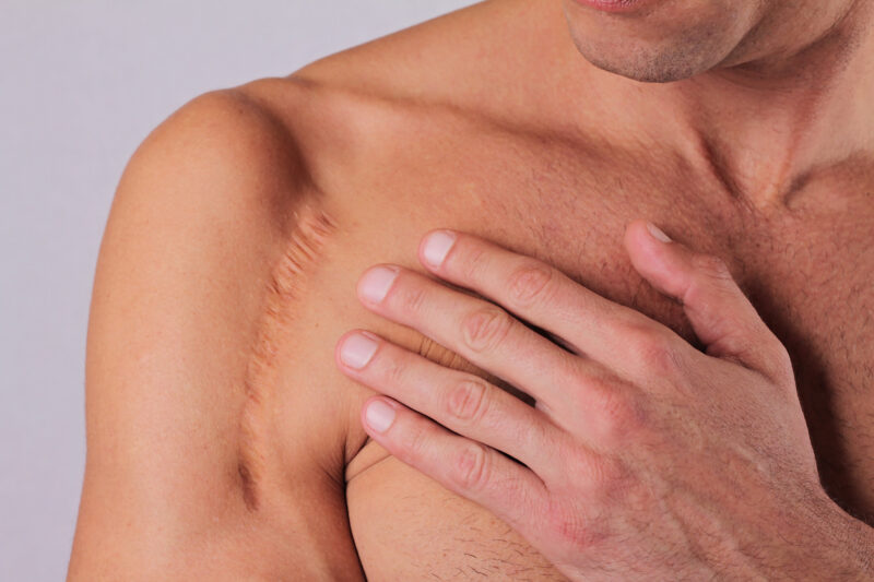 man with scar on his  hand shoulder. Considering scar revision surgery from a plastic surgeon.