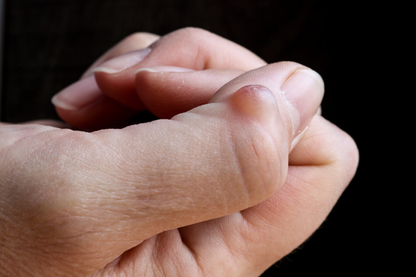 Ganglion cyst (synovial cyst disease) on the thumb of a woman’s hand. Selective focus.Considering surgery