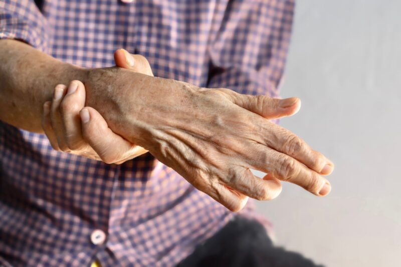 Ulnar claw hand of Asian woman. It develops due to ulnar nerve damage .